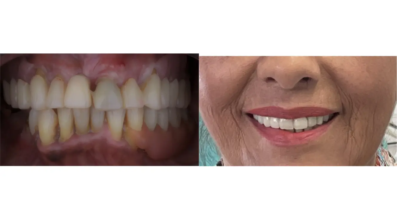 Dental Crown in Bogota, Colombia by Malo Dental
