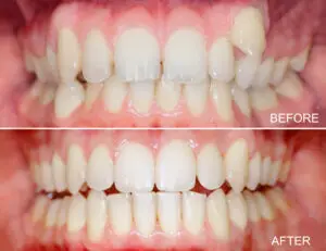 Invisalign & Clear Correct Orthodontics in Bogota, Colombia by Malo Dental