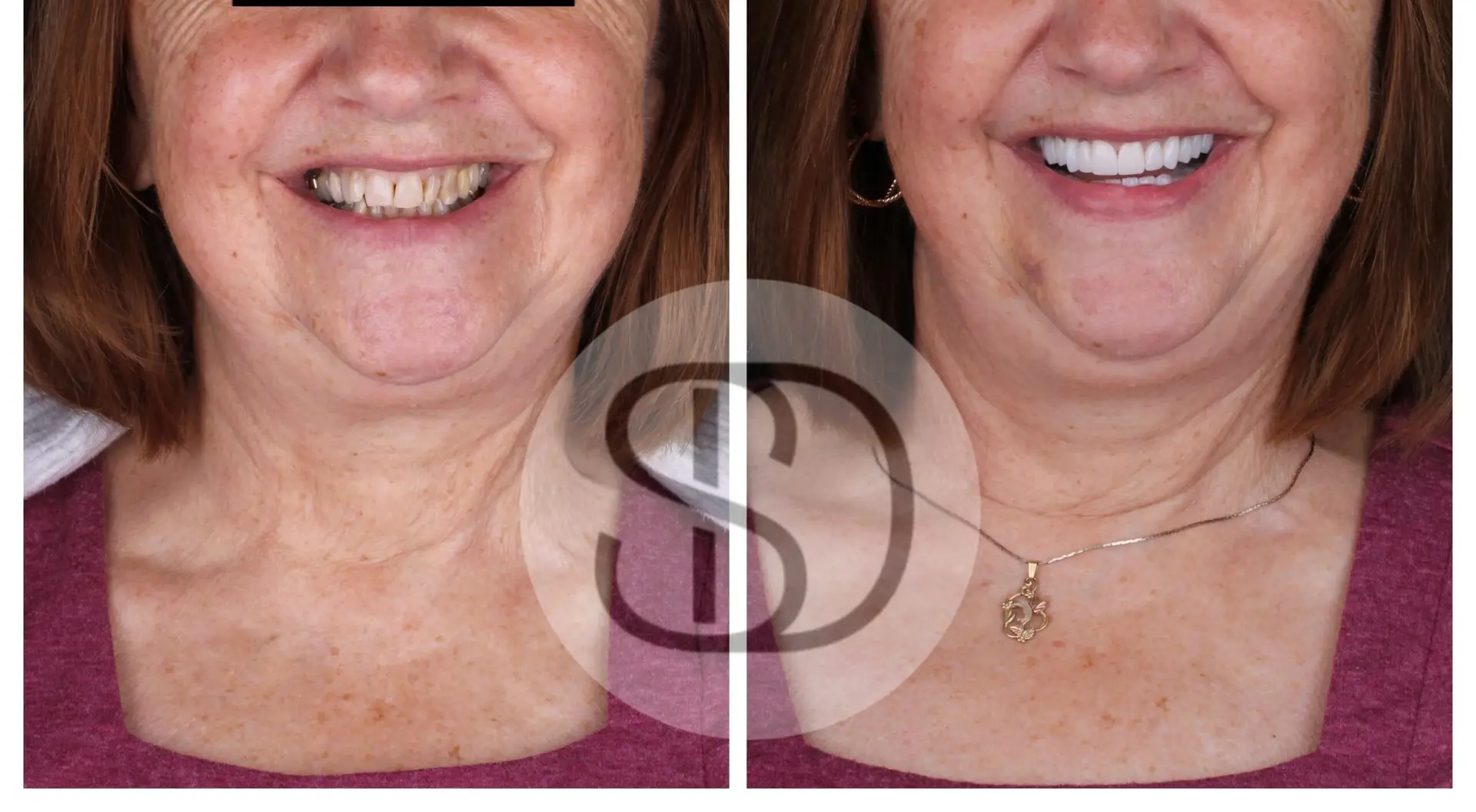 Smile Makeover (16 Zirconia Crowns) in Los Algodones, Mexico by Supreme Dental