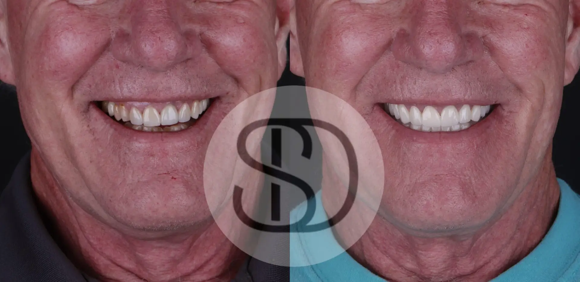 All-on-4 Dental Implants in Los Algodones, Mexico by Supreme Dental Clinic — Procedure Gallery Photo