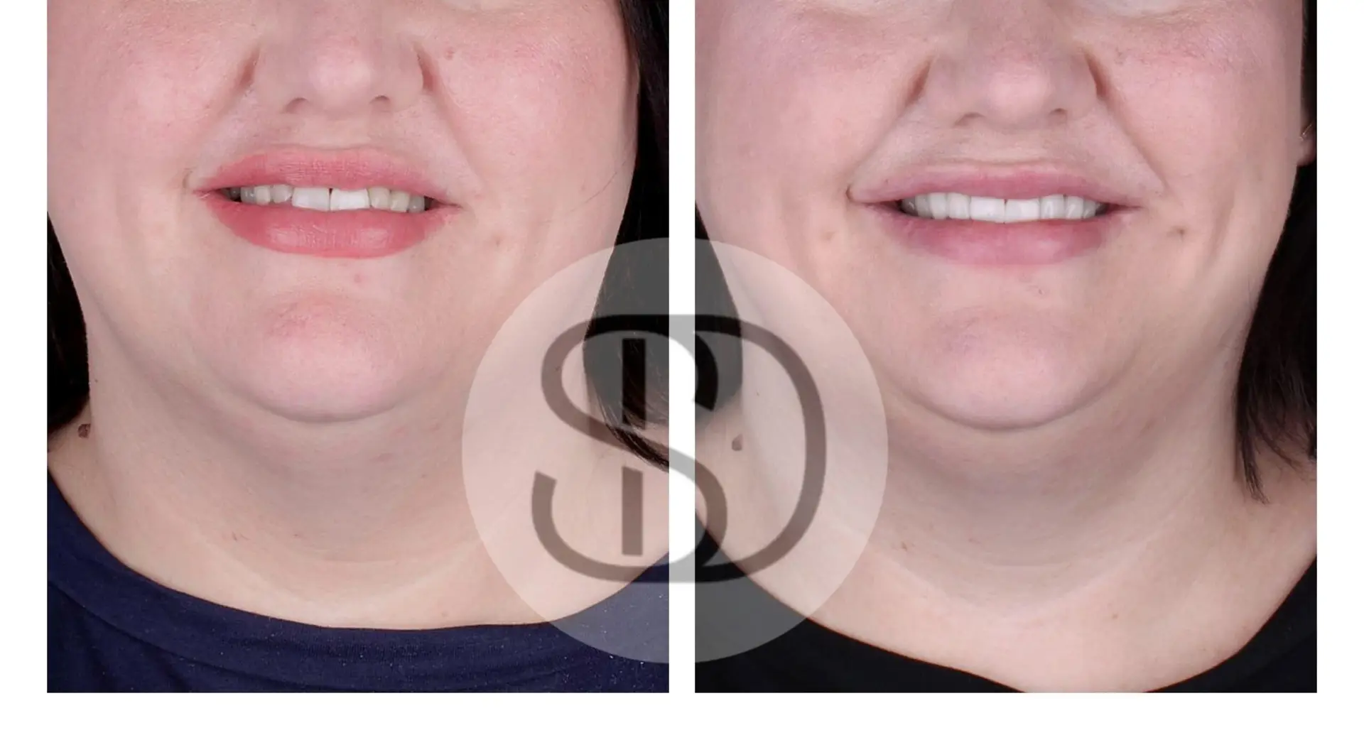 All-on-4 Dental Implants in Los Algodones, Mexico by Supreme Dental Clinic — Procedure Gallery Photo