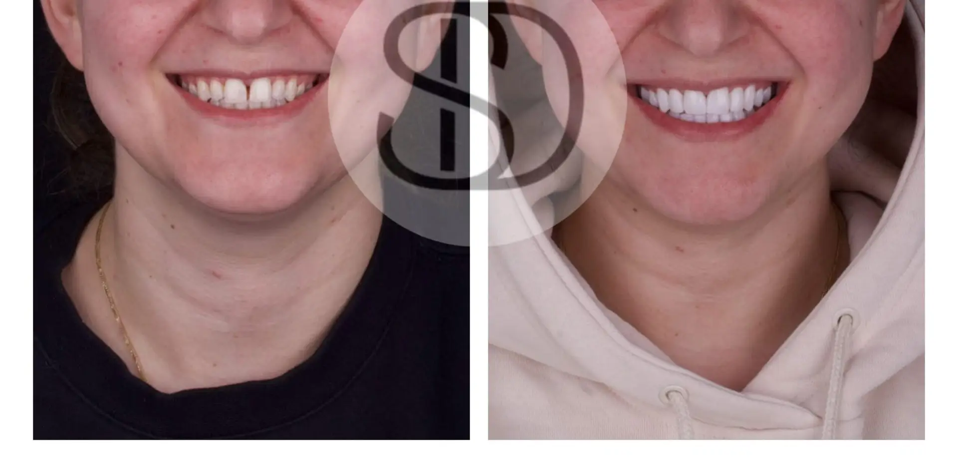 Smile Makeover (16 Zirconia Crowns) in Los Algodones, Mexico by Supreme Dental