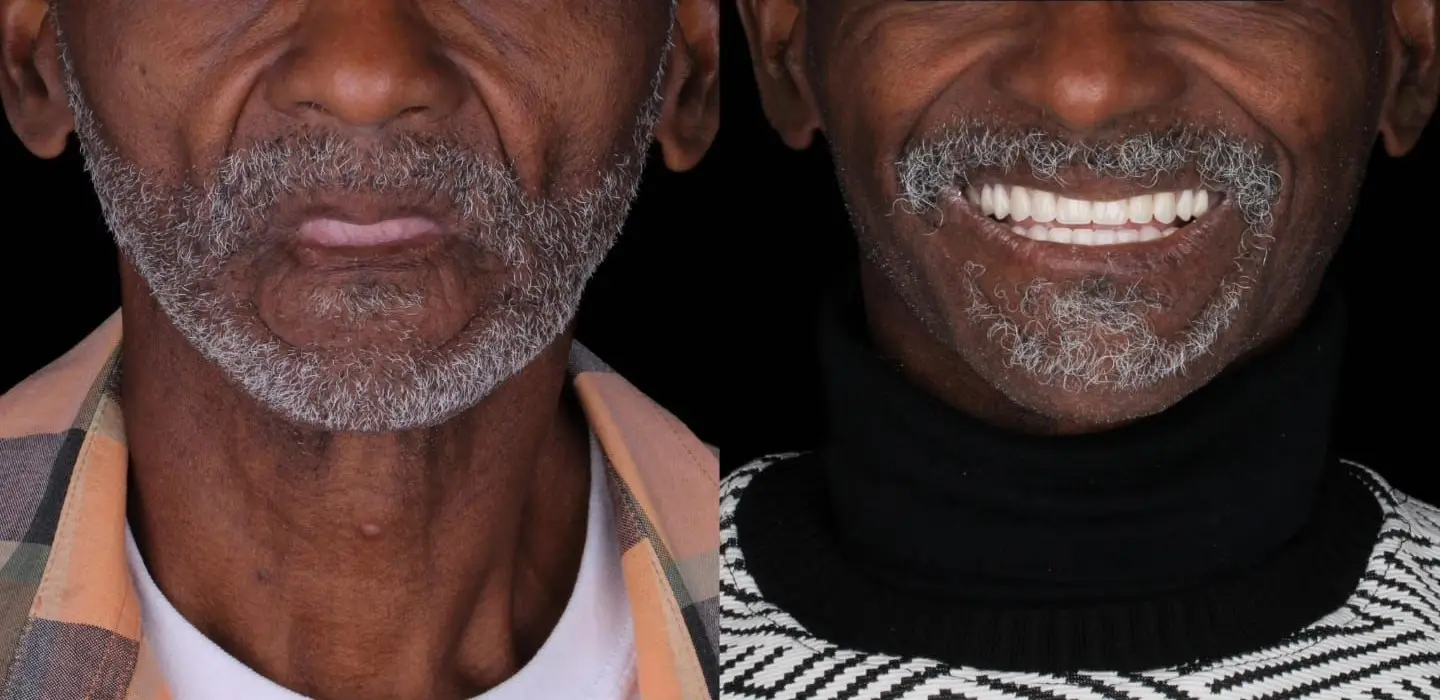 Full Mouth Implants in Istanbul, Turkey by DentSpa