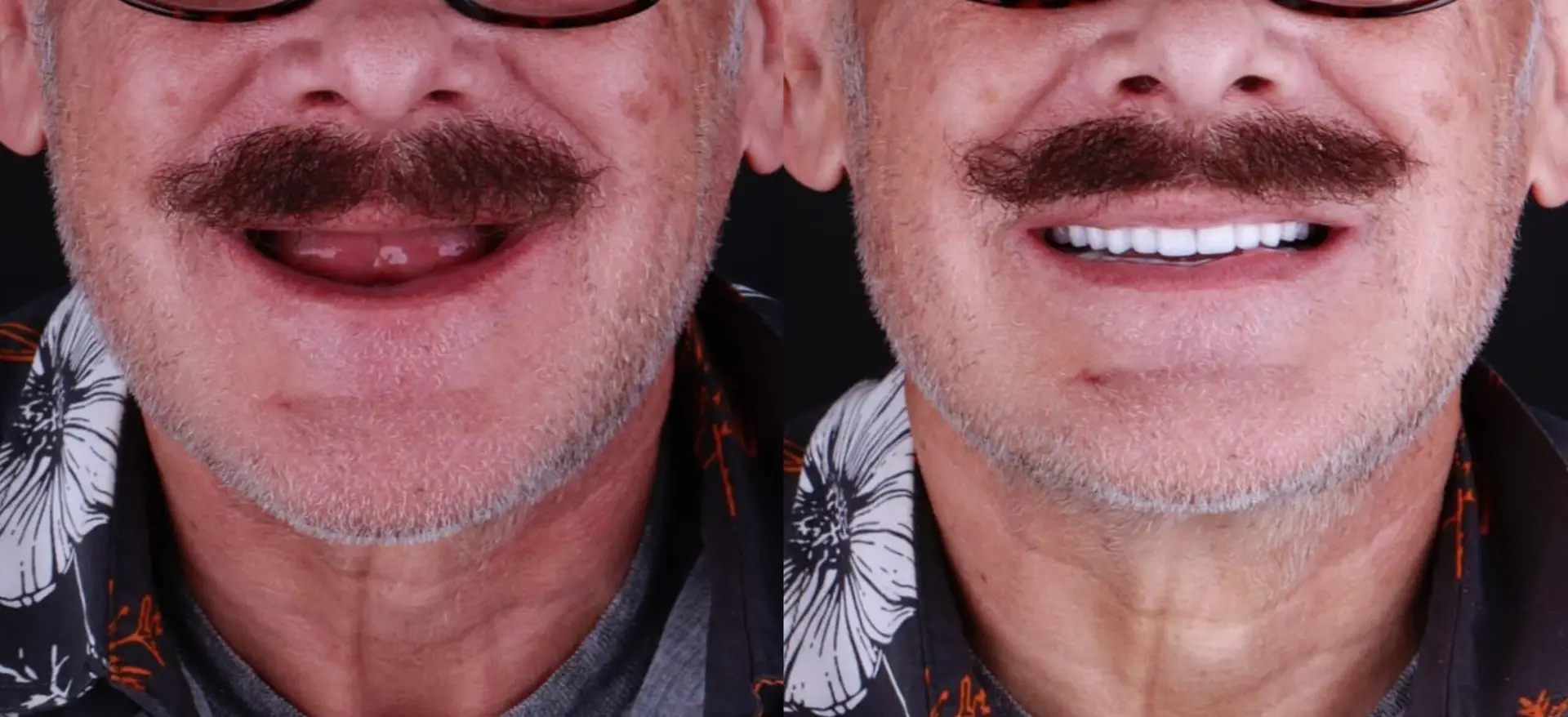 Titanium Implant in Los Algodones, Mexico by Supreme Dental Clinic