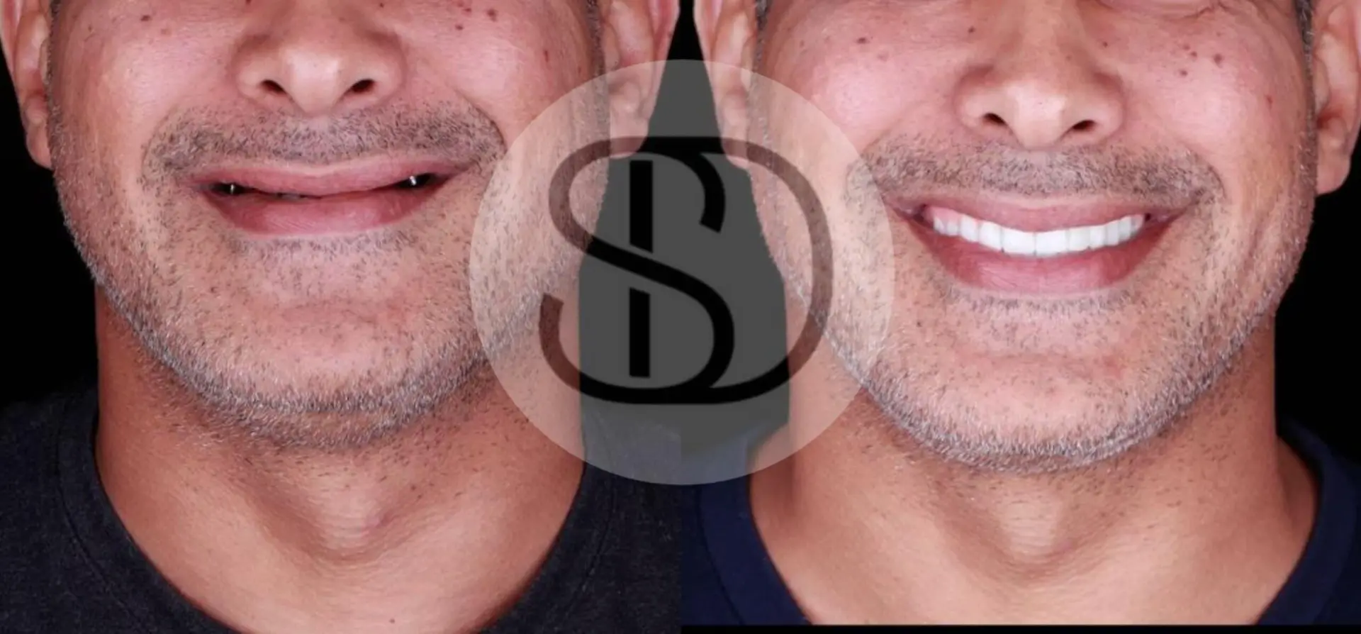 All-on-4 Dental Implants in Los Algodones, Mexico by Supreme Dental Clinic — Procedure Gallery Photo
