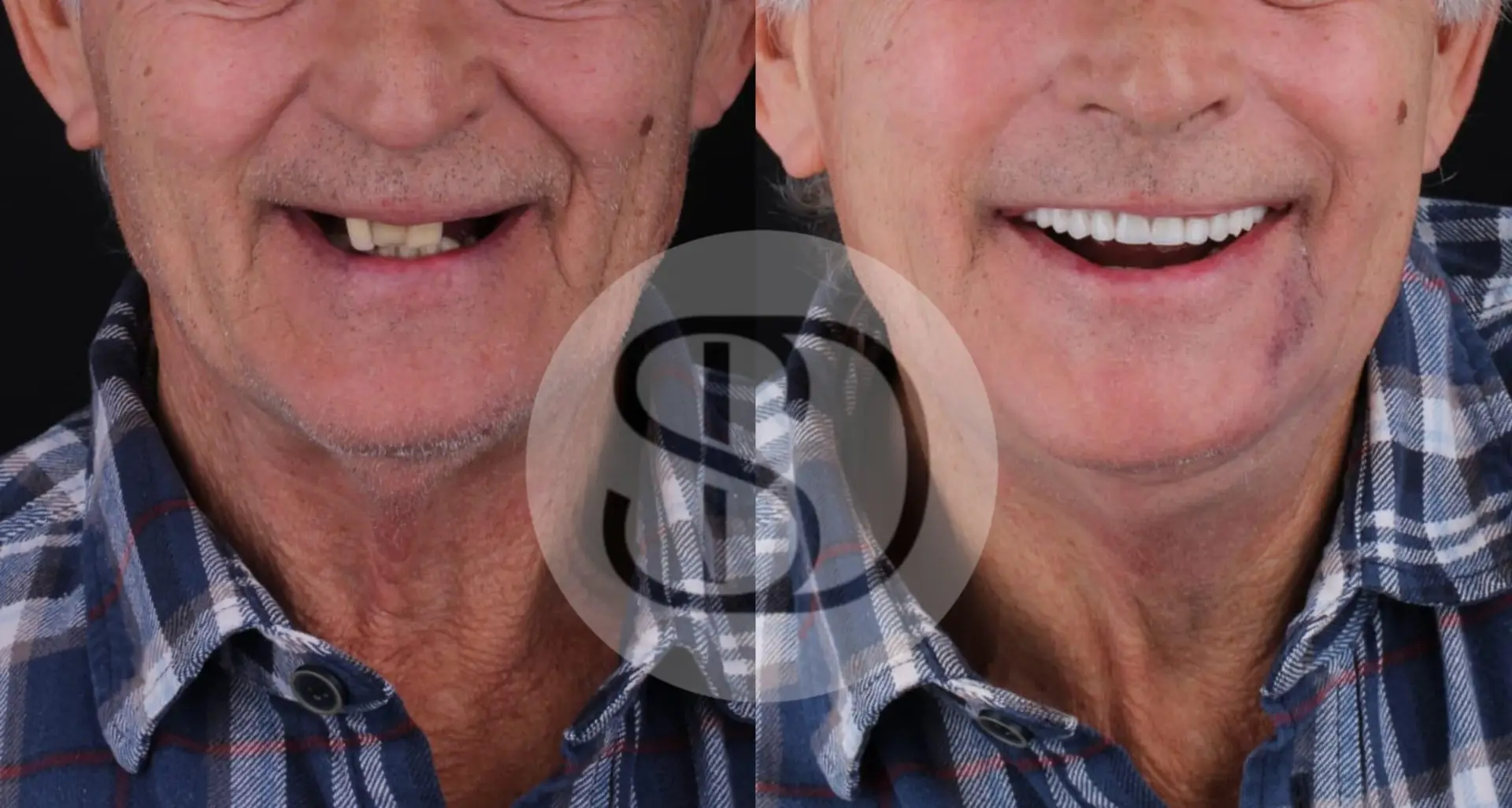 All-on-4 Dental Implants in Los Algodones, Mexico by Supreme Dental Clinic — Procedure Gallery Photo