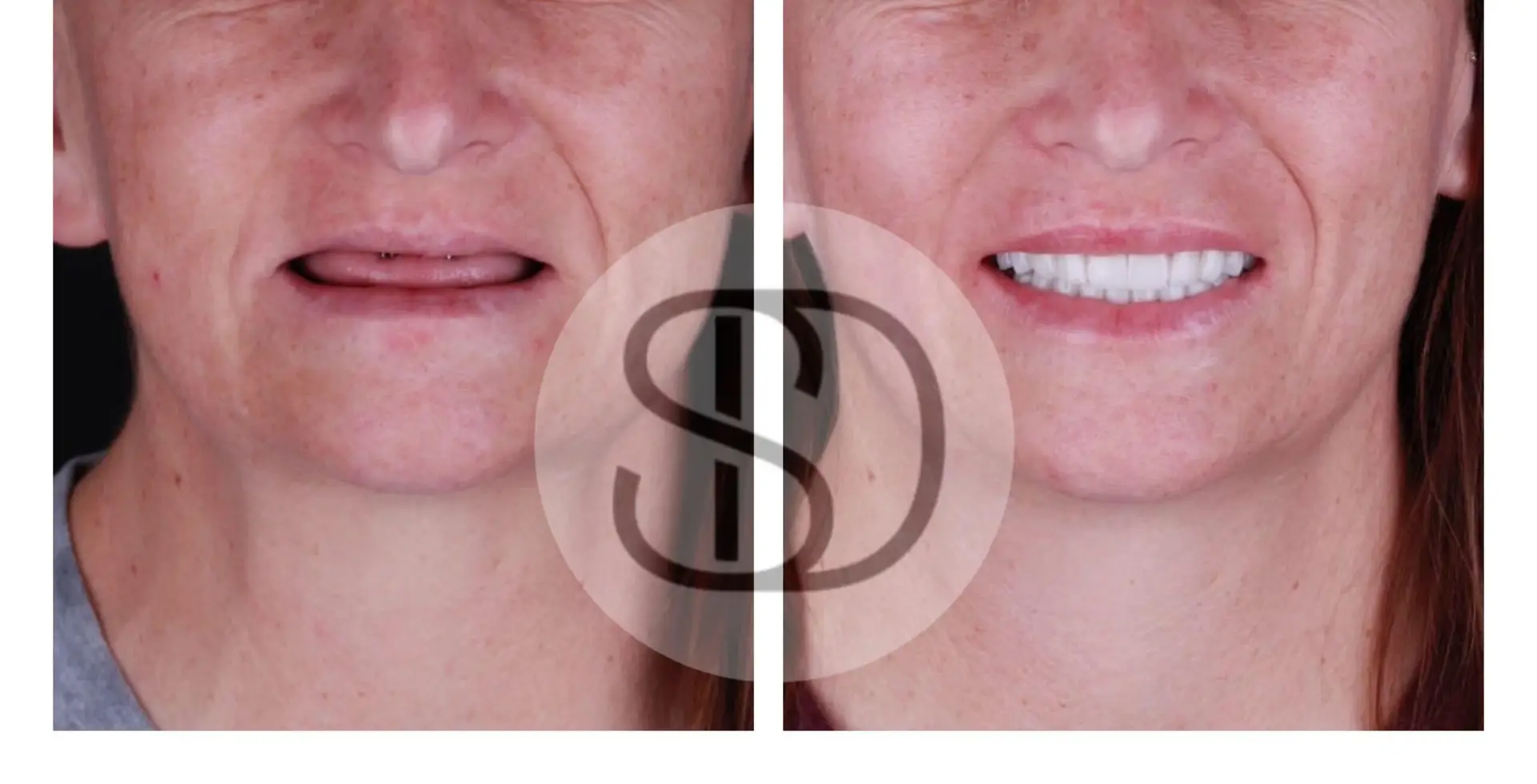 All-on-4 Dental Implants in Los Algodones, Mexico by Supreme Dental Clinic — Procedure Gallery Photo