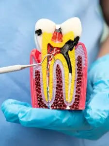 Root Canal Treatment in Bogota, Colombia by Malo Dental