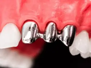 Titanium Implant in Los Algodones, Mexico by Supreme Dental Clinic — Dentistry in Mexico