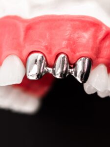 Titanium Implant in Los Algodones, Mexico by Supreme Dental Clinic