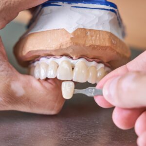 Full Mouth Implants in Istanbul, Turkey by DentSpa — Dentistry in Turkey