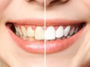 Dental Veneers in Bogota, Colombia by Malo Dental — Dentistry in Colombia