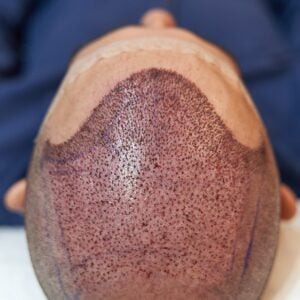 Unshaved Hair Transplant in Istanbul, Turkey by Memorial Hospital — Hair Restoration Surgery in Turkey