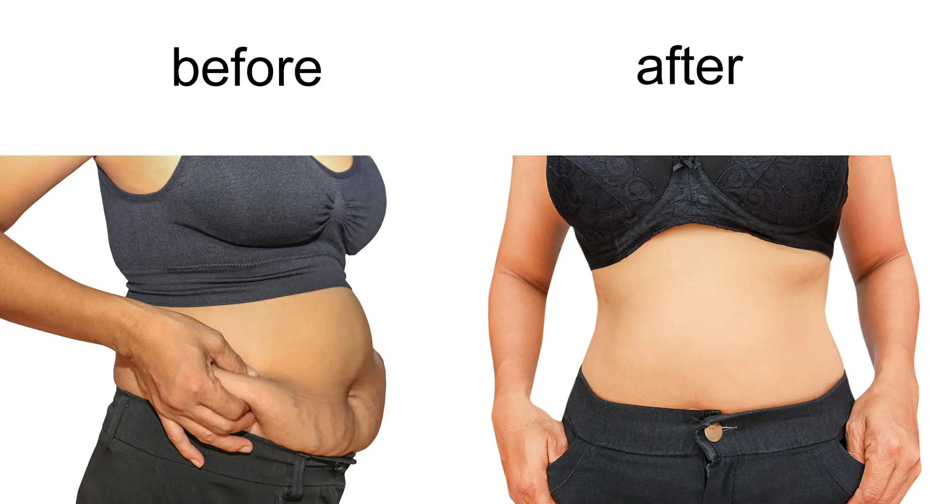 Tummy Tuck in Bangkok, Thailand by Wansiri Hospital