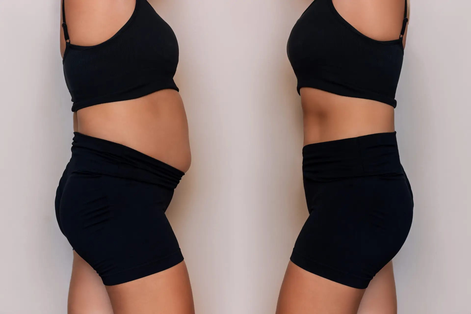 Gastric Sleeve Surgery in Playa del Carmen, Mexico by CostaMed Medical Group — Procedure Gallery Photo