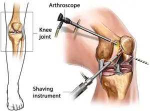 Arthroscopic Surgery in San José, Costa Rica by Dr. Aria Alexander Ravery Morovati at Dr. Aria Alexander Ravery Morovati — Orthopedics Procedure Abroad