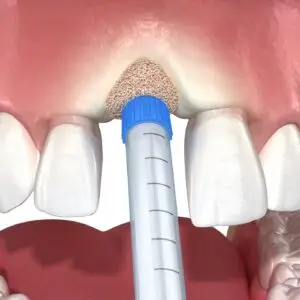 Bone Grafting Clinics and Procedures Abroad