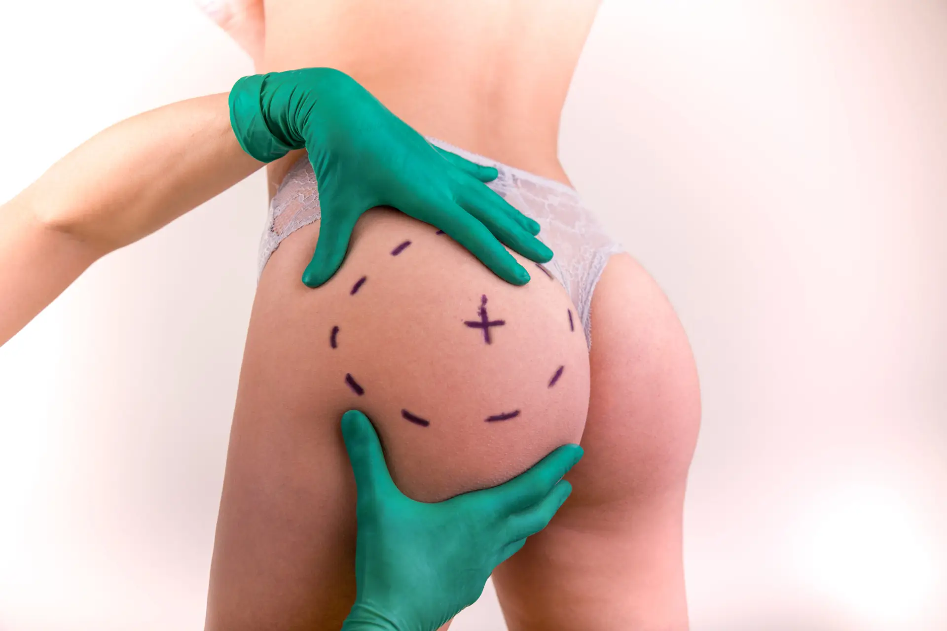Brazilian Butt Lift in Bangkok, Thailand by Wansiri Hospital