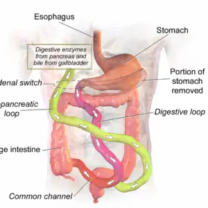 Biliopancreatic Diversion with Duodenal Switch Clinics and Procedures Abroad