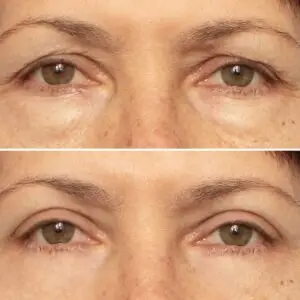 Eyelid Surgery Clinics and Procedures Abroad
