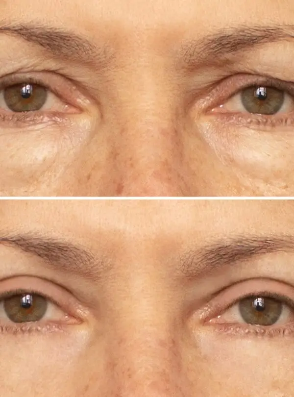 eyelid-square-2