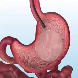 Gastric Balloon in Istanbul, Turkey by Avicenna Hospital