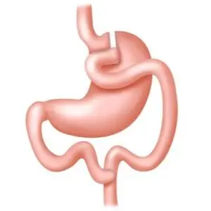 Gastric Bypass Clinics and Procedures Abroad
