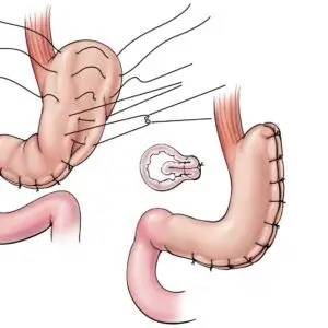 Gastric Plication Clinics and Procedures Abroad