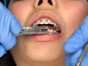 Orthodontics Clinics and Procedures Abroad
