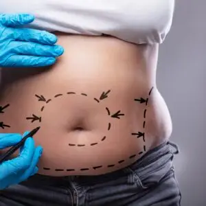 Liposuction Clinics and Procedures Abroad