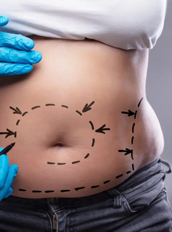 liposuction-square