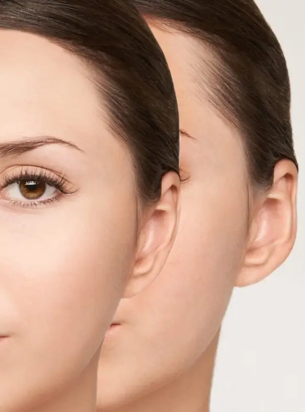 otoplasty-square-2