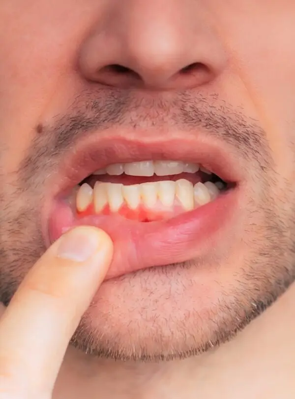 periodontal-square