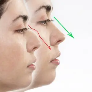Rhinoplasty Clinics and Procedures Abroad