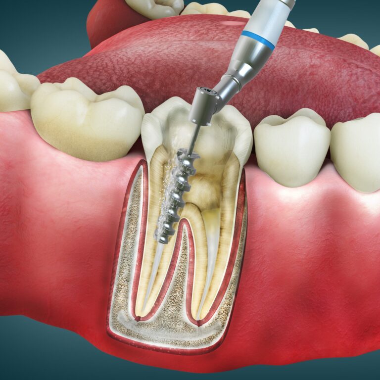 Root Canal Retreatment in Bogota, Colombia by Malo Dental