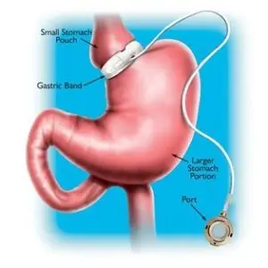 Gastric Band Adjustment Clinics and Procedures Abroad