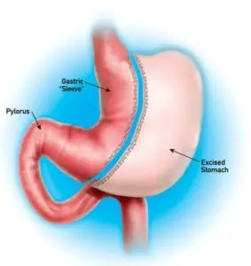 Gastric Sleeve Clinics and Procedures Abroad