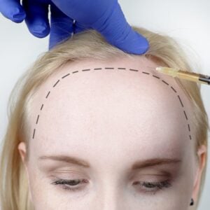 Female Hair Transplant in Istanbul, Turkey by Medical Park Hospitals — Hair Restoration Surgery in Turkey