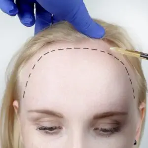 Female Hair Transplant in Istanbul, Turkey by Medical Park Hospitals
