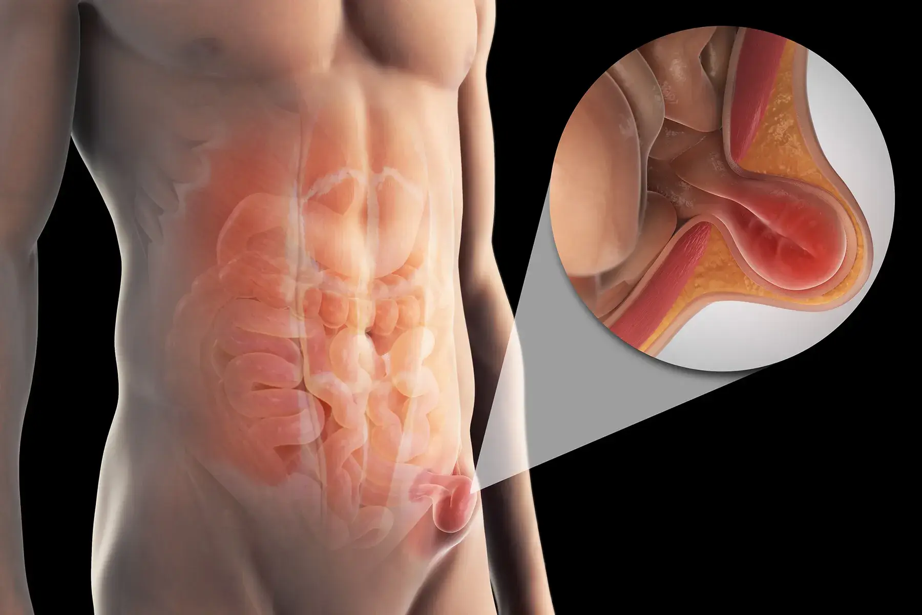Hernia Surgery in Istanbul, Turkey by Avicenna Hospital — Procedure Gallery Photo