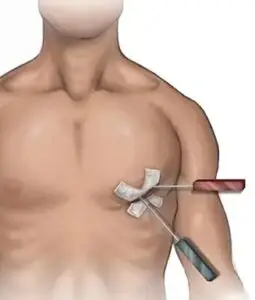 Arterial and Venous Grafting Clinics and Procedures Abroad