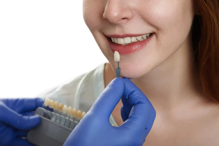 Cheapest Places to Get Veneers in the World — Dental Veneer Medical Tourism Guide in Colombia