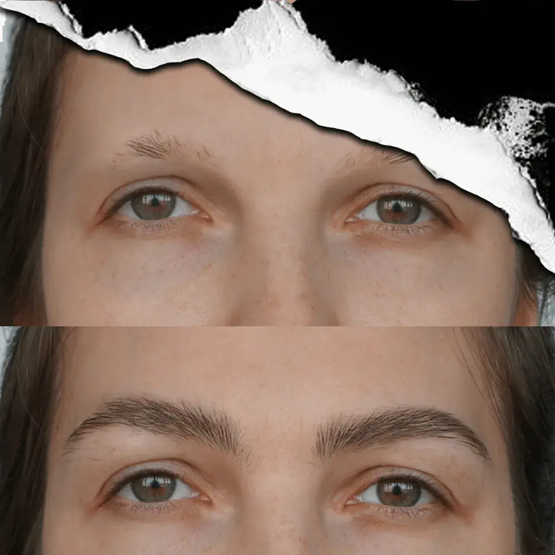 Eyebrow Transplantation in Istanbul, Turkey by International Plus