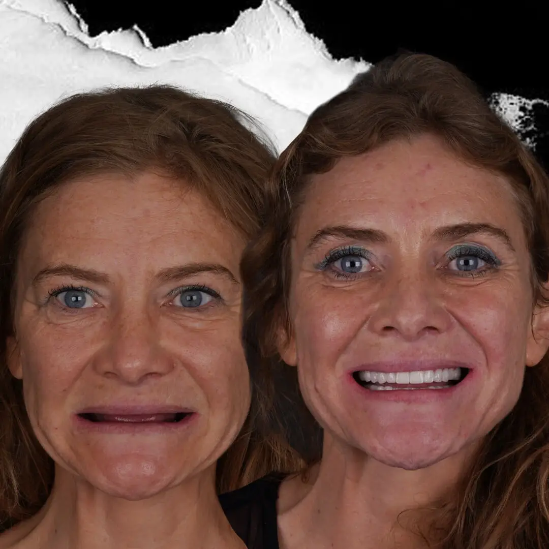 Dental Implants in Istanbul, Turkey by International Plus