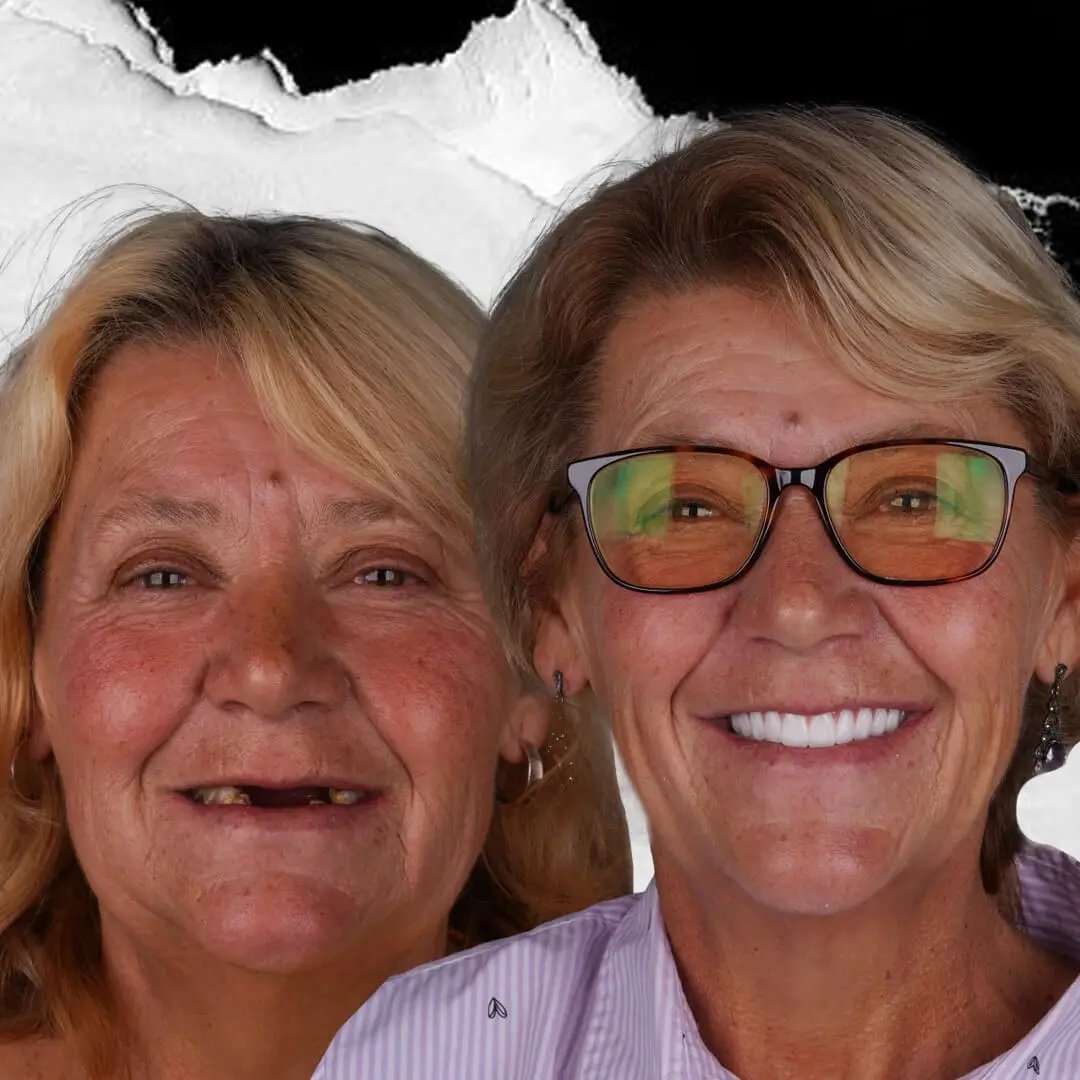 Dental Implants in Istanbul, Turkey by International Plus