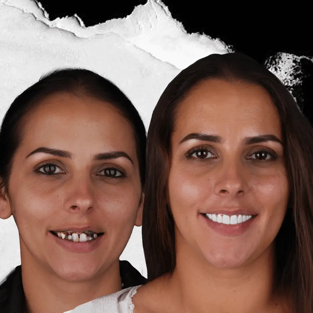 Dental Implants in Istanbul, Turkey by International Plus