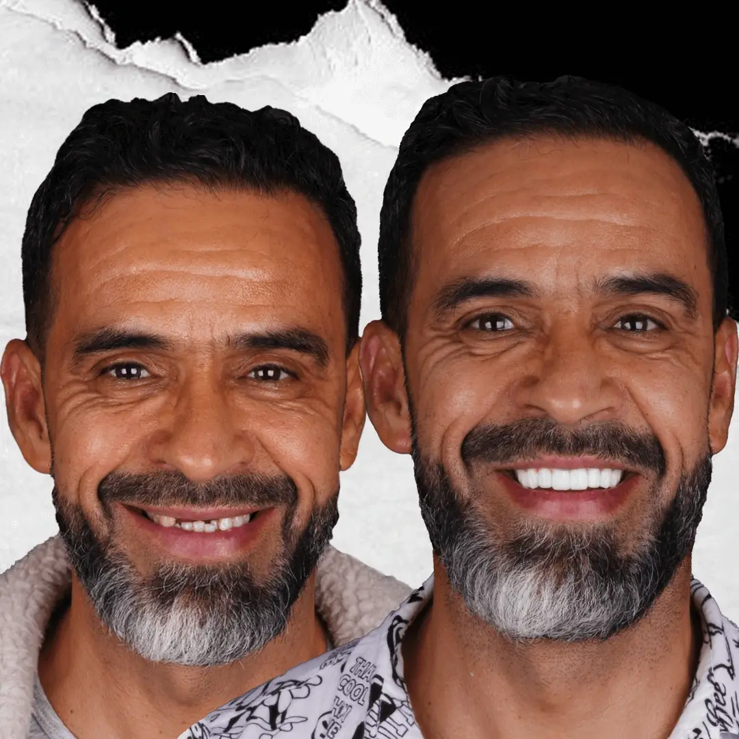 Dental Implants in Istanbul, Turkey by International Plus