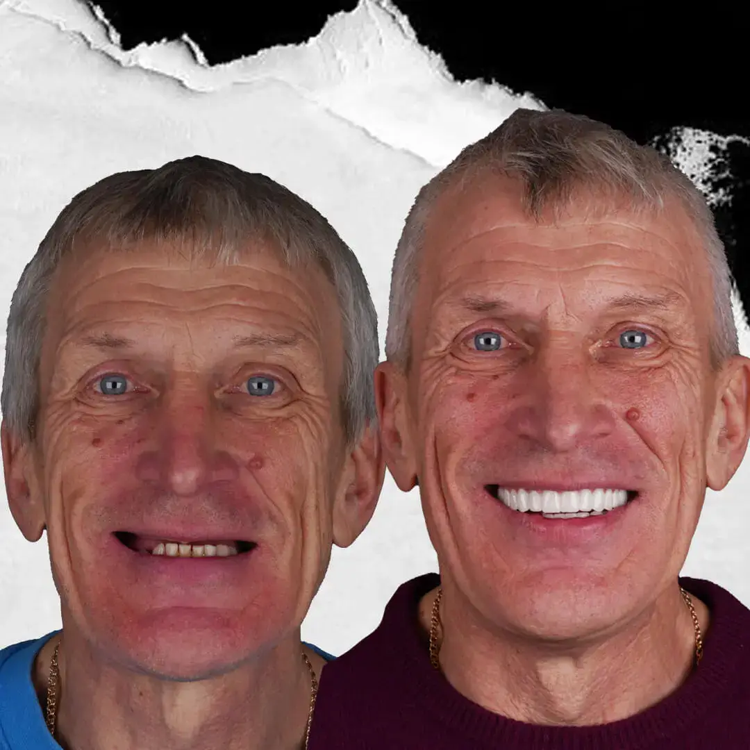 Dental Implants in Istanbul, Turkey by International Plus