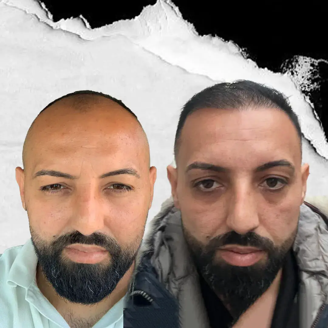 DHI (Direct Hair Implantation) Hair Transplant in Istanbul, Turkey by International Plus