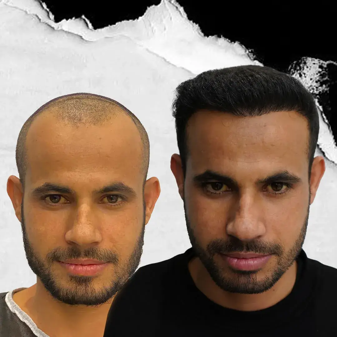 Hair Transplant in Istanbul, Turkey by International Plus